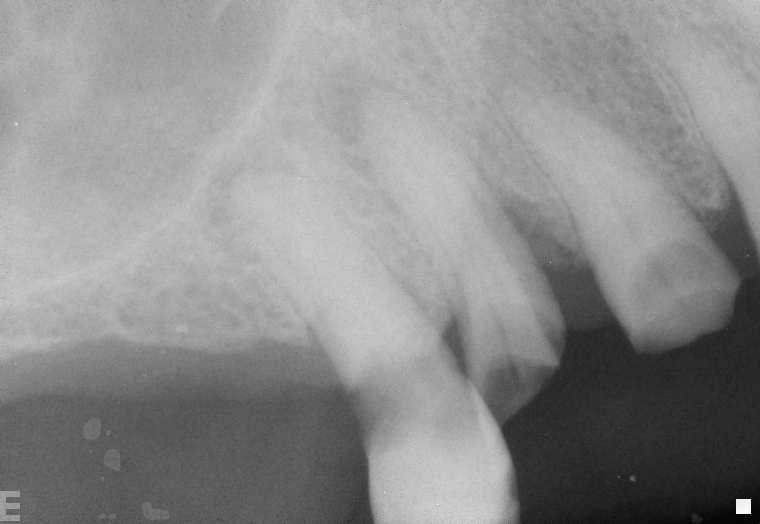 DIGITAL XRAY OF ABCESS