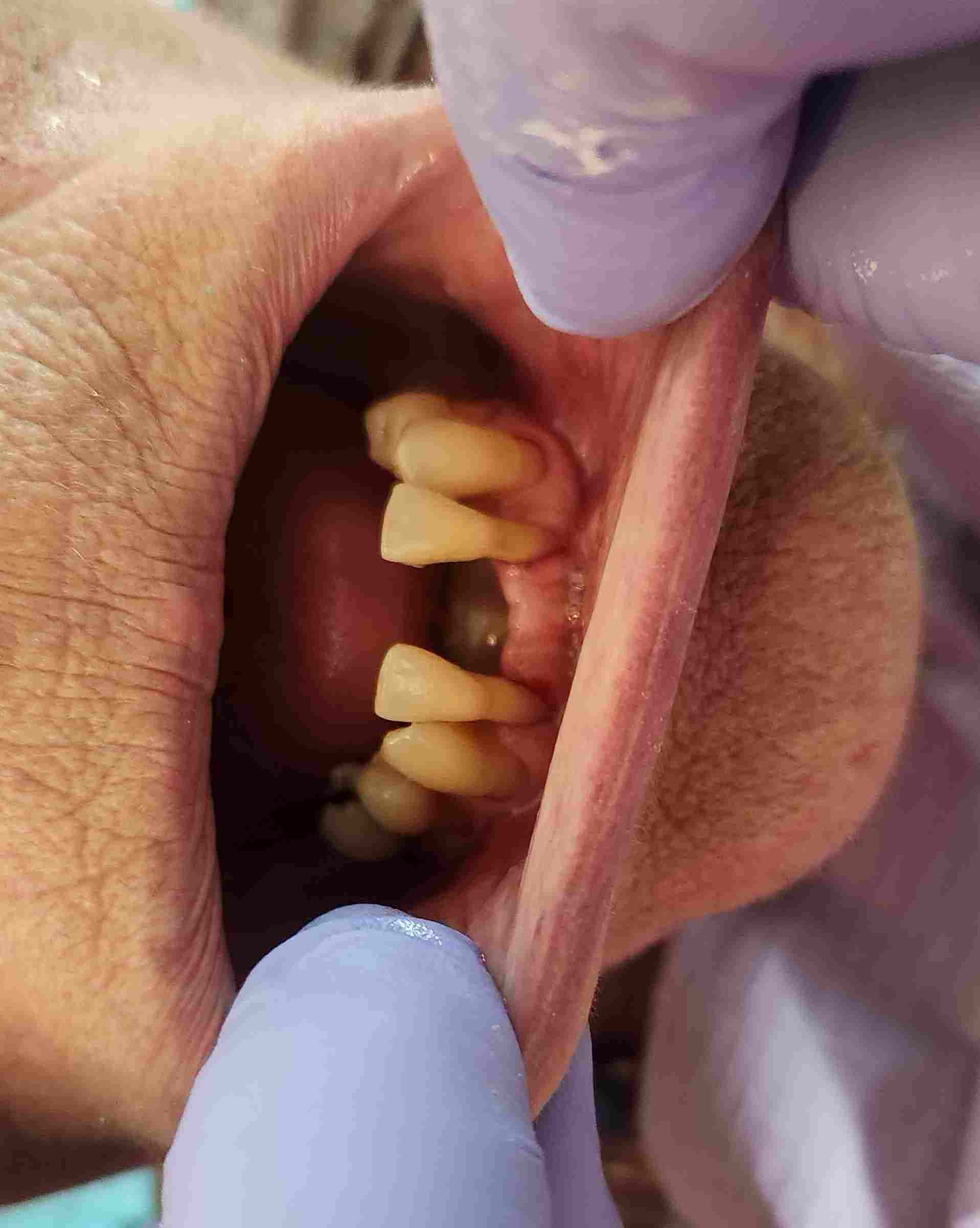 Teeth to be shortened for overdenture